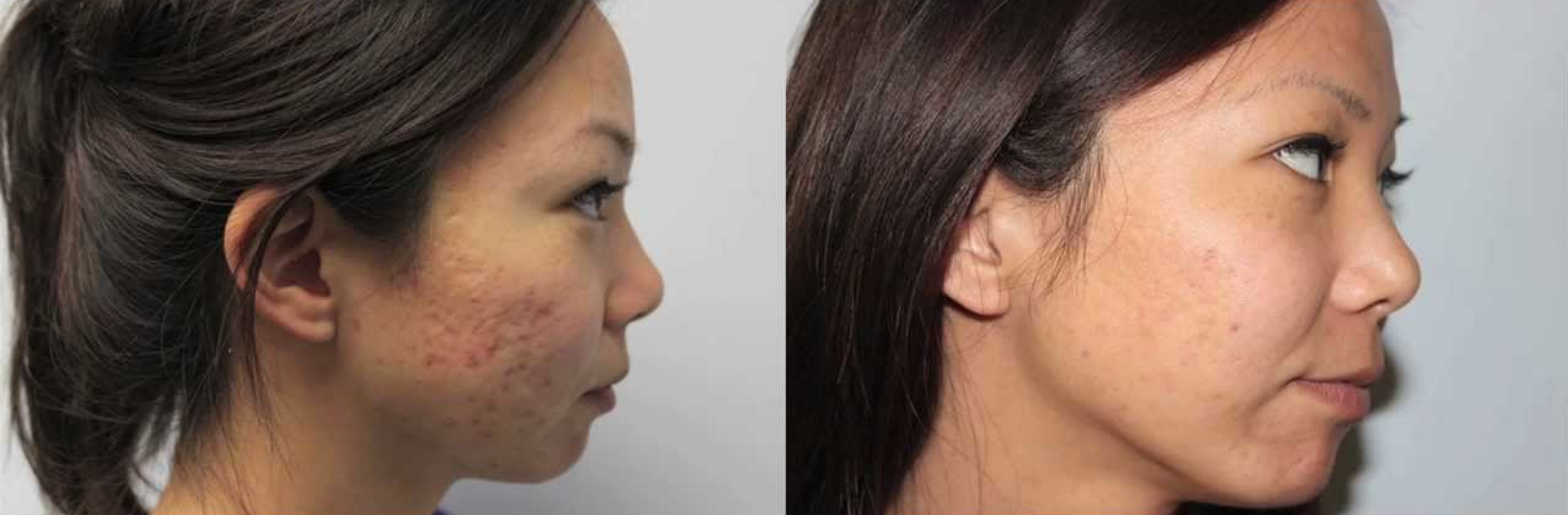 ipl laser acne treatment