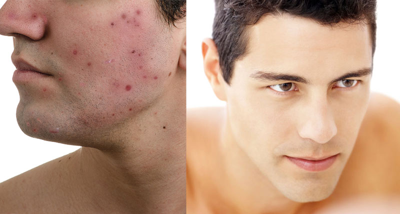 men acne treatment package