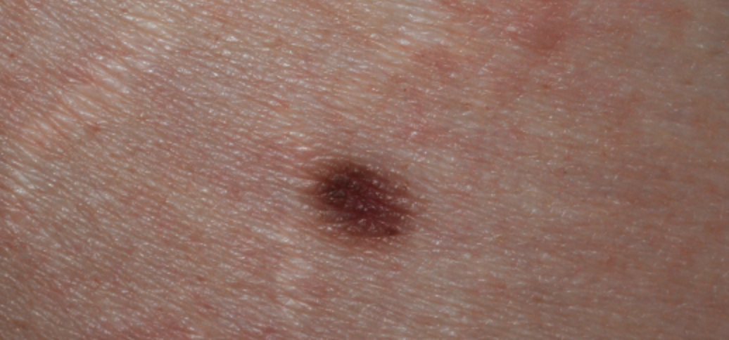 pigmented lesions laser treatment