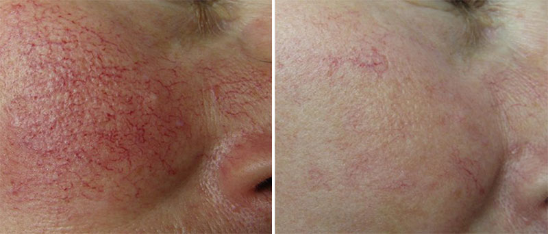 vascular lesions laser treatment