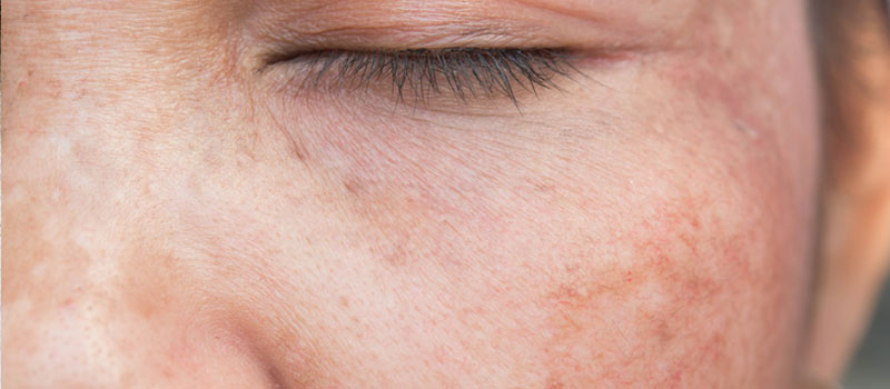 sun damage and uneven pigmentation facials