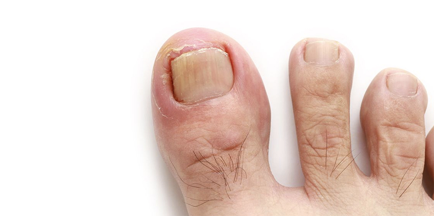 ingrown toenails