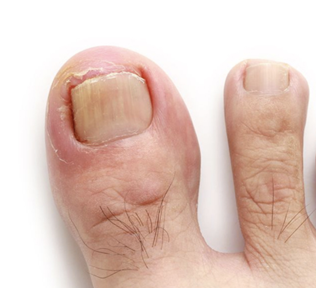 ingrown toenails